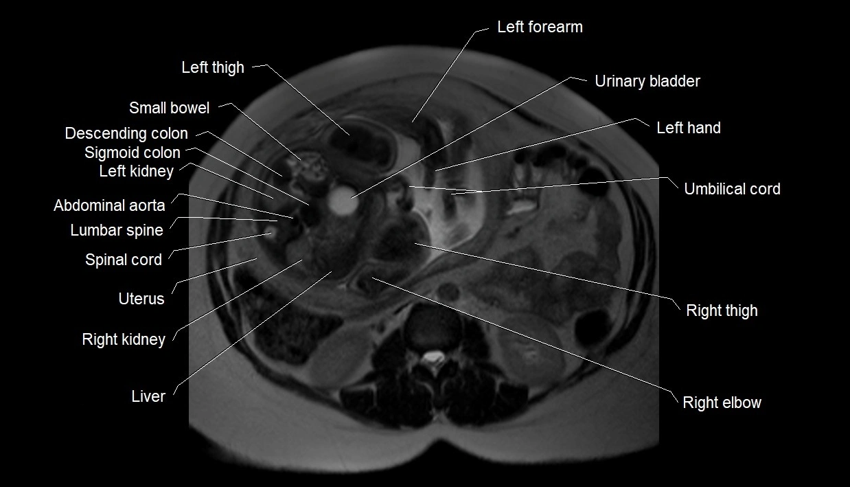 MRI fetal anatomy axial image 8.webp